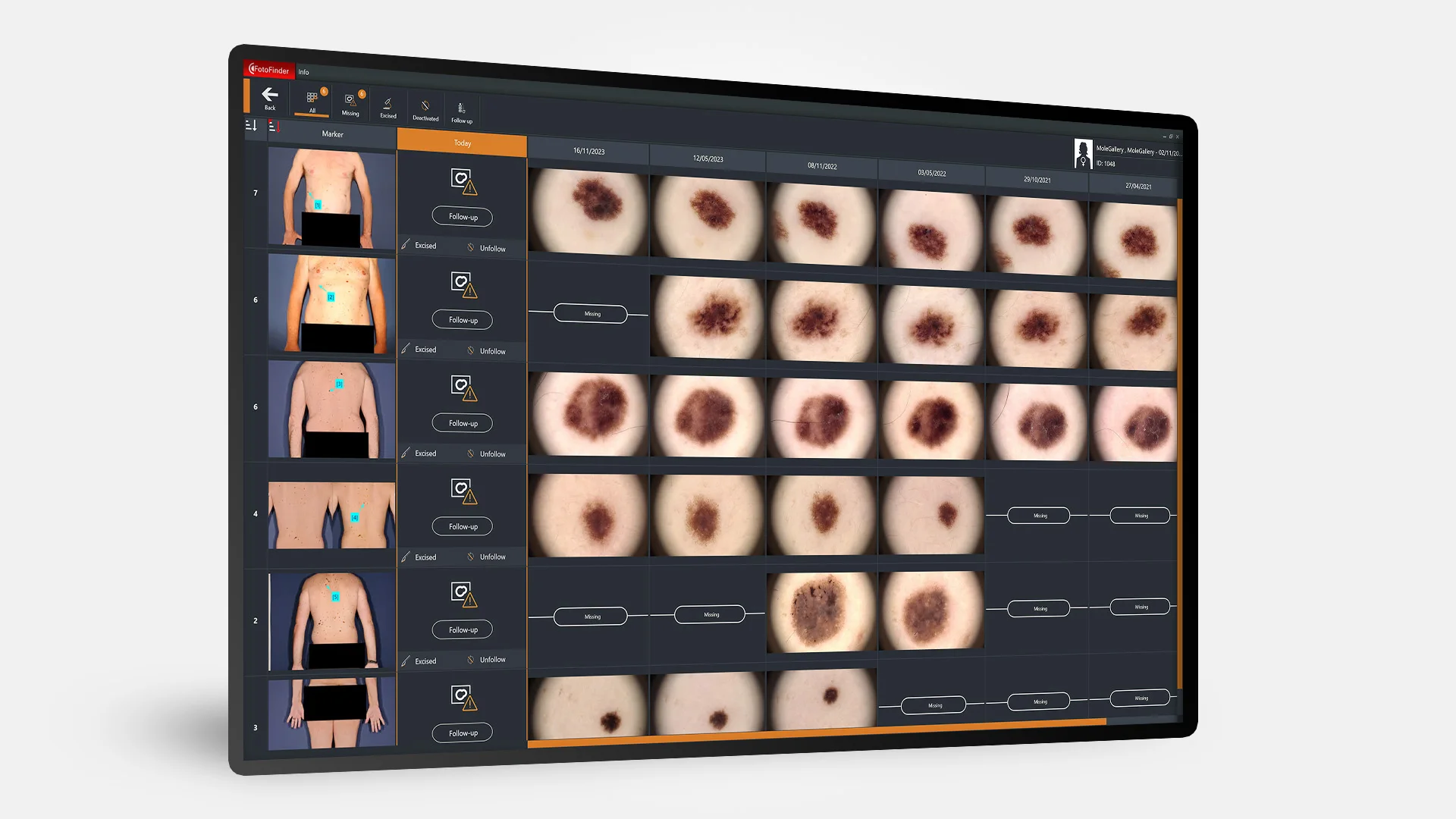 皮膚がんスクリーニング