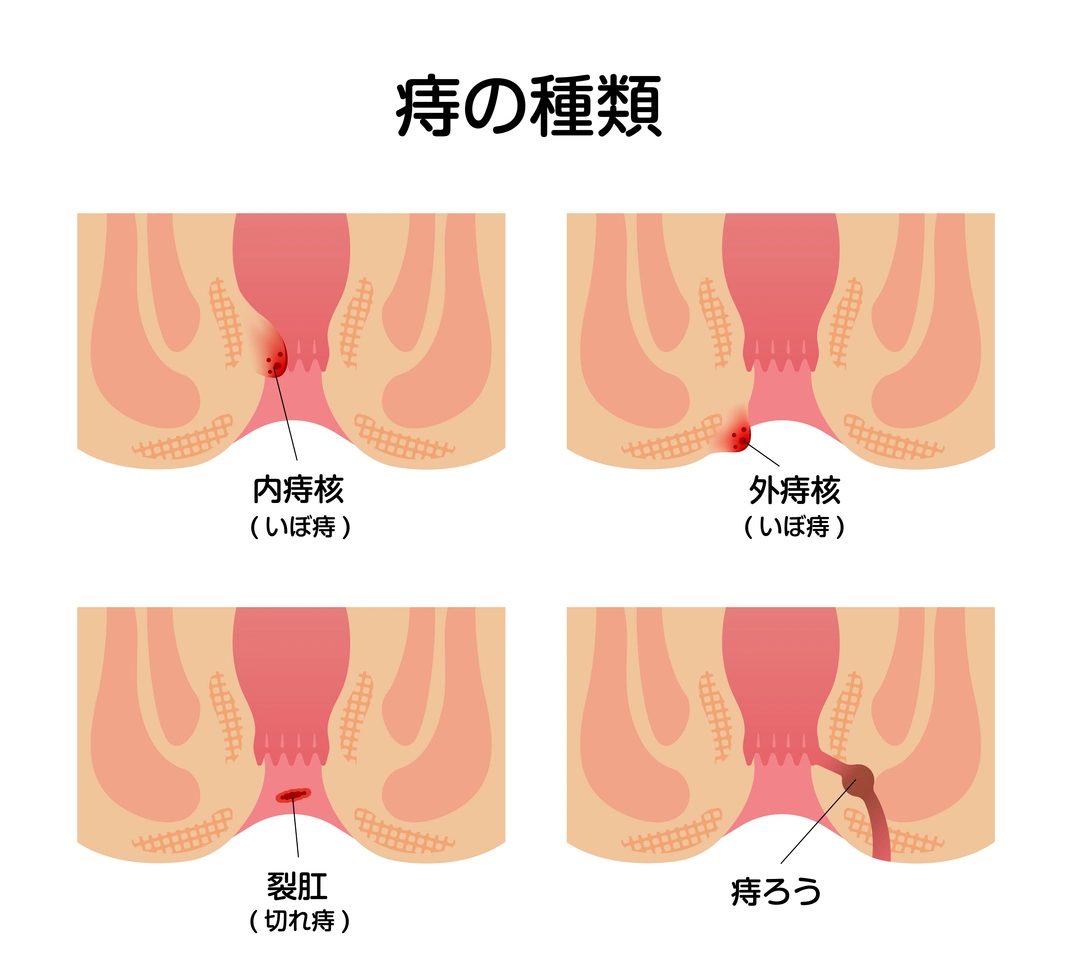 痔の種類
