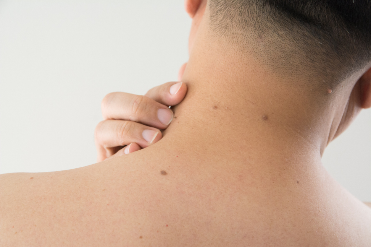 ほくろチェック
