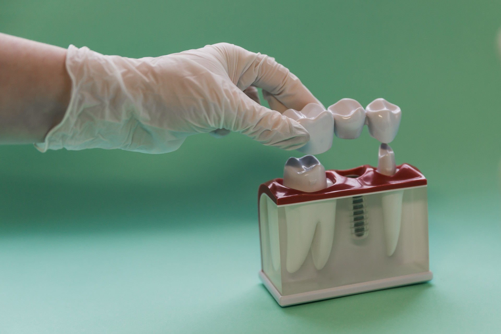 インプラント・クラウン・ラミネートベニア（タイ・バンコク）