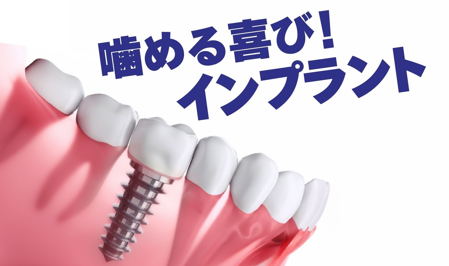 インプラント