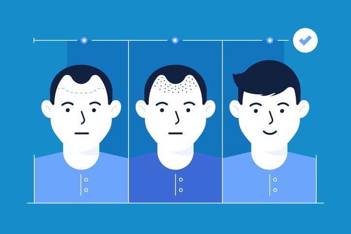 AGA（男性型脱毛症）治療・自毛植毛プログラム